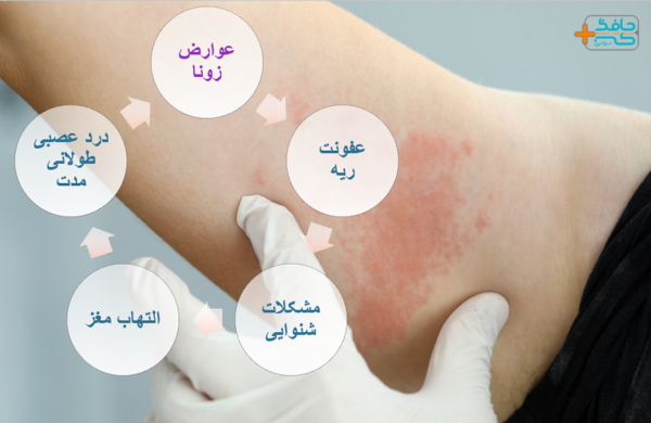  آیا زونا برای زن باردار خطرناک است؟