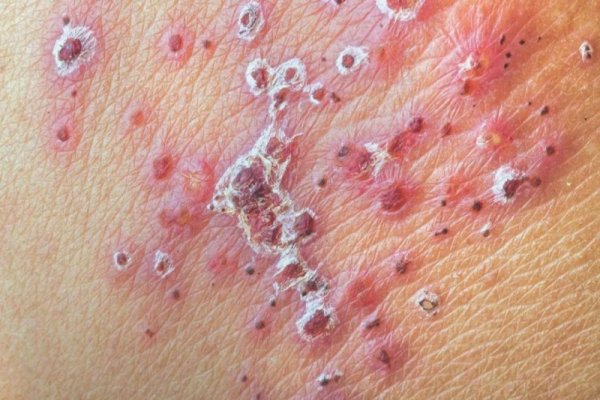  آیا زونا برای زن باردار خطرناک است؟