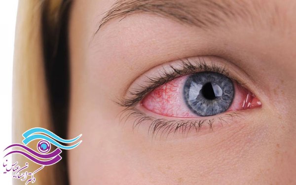  آیا زونا برای زن باردار خطرناک است؟