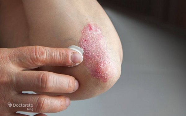  آنتی بیوتیک برای درمان زونا