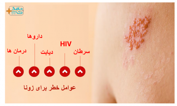  آنتی بیوتیک برای درمان زونا