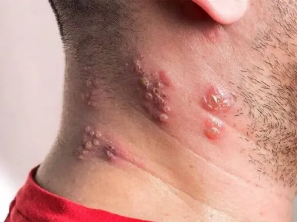  چه کسانی باید واکسن زونا بزنند؟