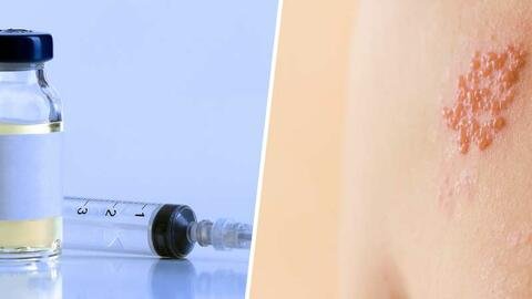  چه کسانی باید واکسن زونا بزنند؟