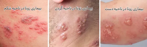  آیا زونا برای جنین خطرناک است؟