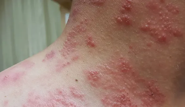  آیا زونا برای جنین خطرناک است؟