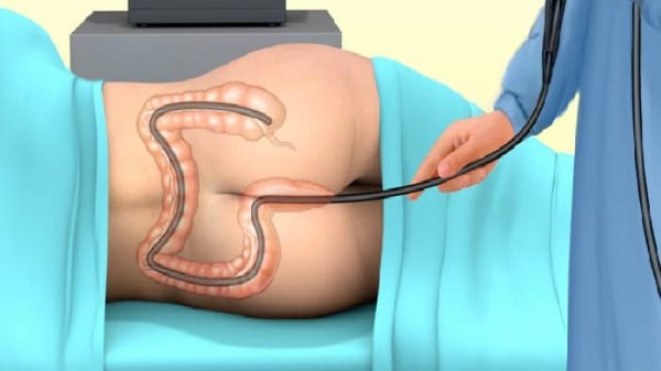 فیلم کولونوسکوپی زن