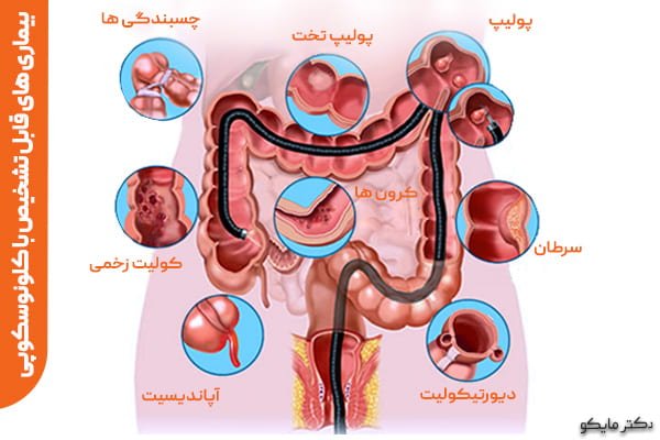  فیلم کولونوسکوپی زن