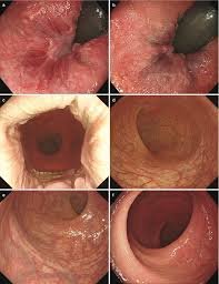  فیلم کولونوسکوپی زن