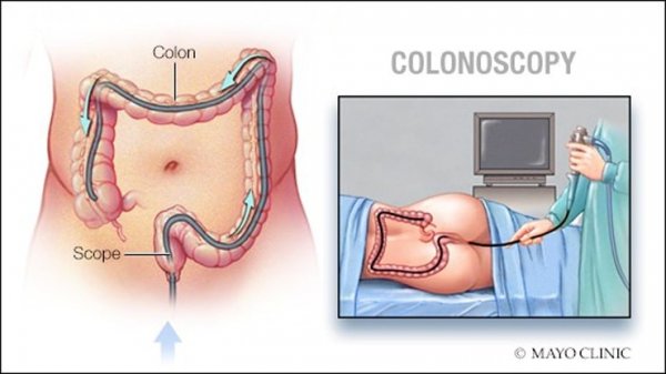  فیلم کولونوسکوپی زن