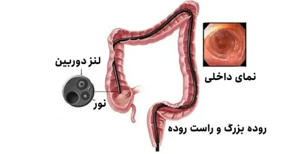  فیلم کولونوسکوپی زن