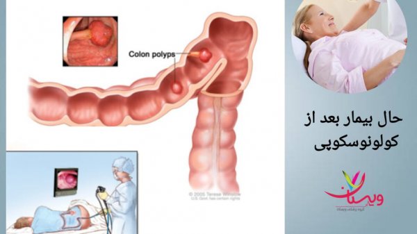 کمردرد بعد از کولونوسکوپی