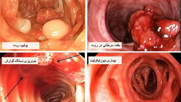  کمردرد بعد از کولونوسکوپی