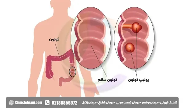  ریکاوری بعد از کولونوسکوپی