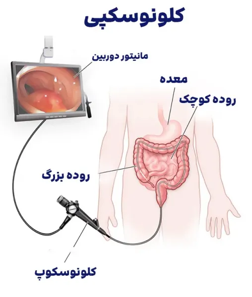  ریکاوری بعد از کولونوسکوپی