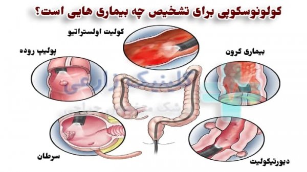  ریکاوری بعد از کولونوسکوپی