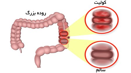 عکس + فیلم کولیت روده