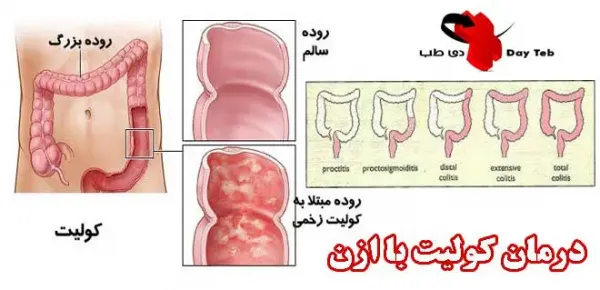  عکس + فیلم کولیت روده
