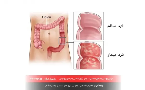  عکس + فیلم کولیت روده