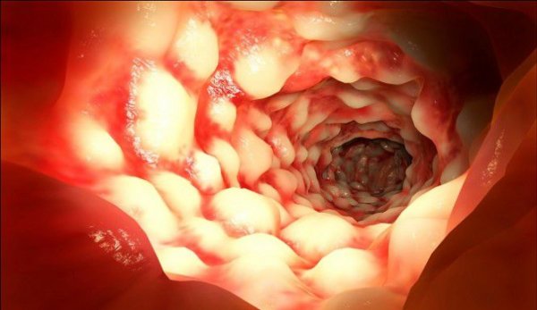  درمان سریع و قطعی التهاب روده