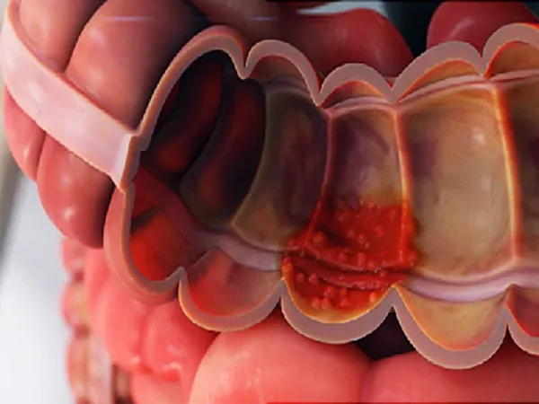  عکس زخم روده