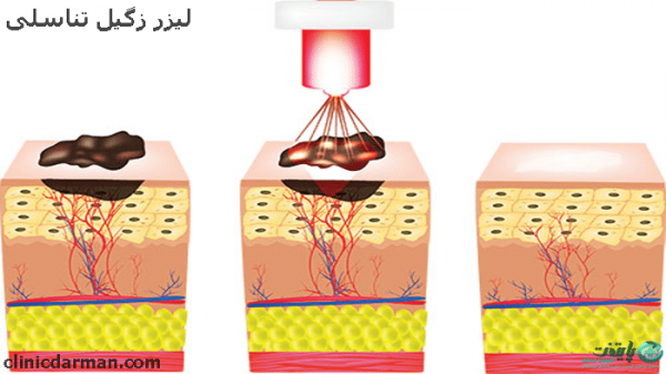  آیا برداشتن زگیل تناسلی درد دارد؟