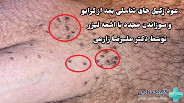  آیا برداشتن زگیل تناسلی درد دارد؟