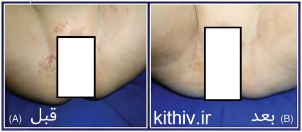  آیا برداشتن زگیل تناسلی درد دارد؟