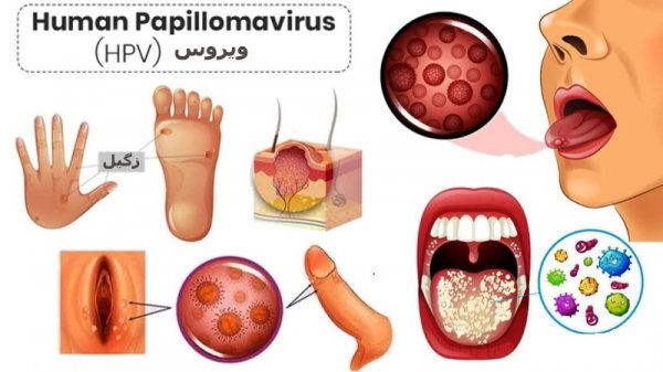  آیا زگیل تناسلی بعد از درمان قابل انتقال است؟