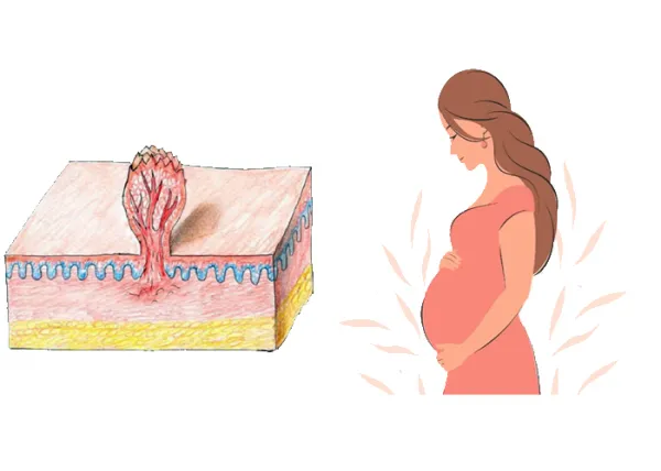  آیا بعد از درمان زگیل تناسلی میتوان بچه دار شد؟