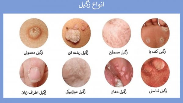  آیا بعد از درمان زگیل تناسلی میتوان بچه دار شد؟