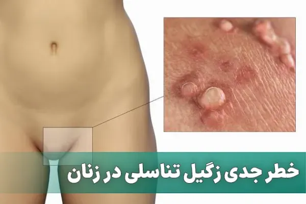  آیا بعد از درمان زگیل تناسلی میتوان بچه دار شد؟