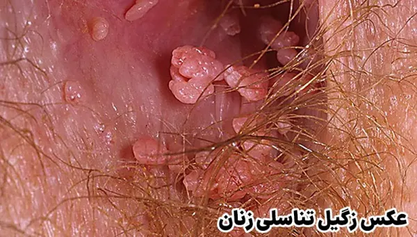  آیا بعد از درمان زگیل تناسلی میتوان بچه دار شد؟