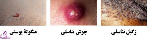  عوارض کرایوتراپی زگیل تناسلی