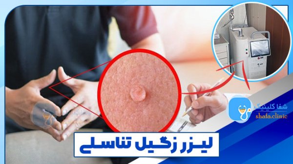 آیا لیزر زگیل تناسلی درد دارد؟