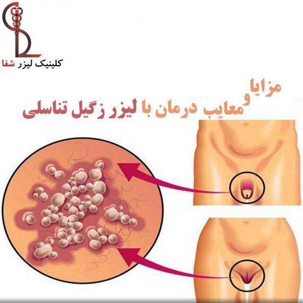  آیا لیزر زگیل تناسلی درد دارد؟