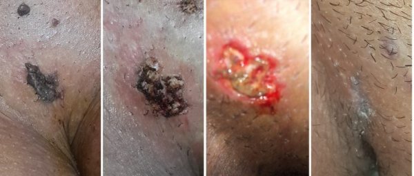  آیا لیزر زگیل تناسلی درد دارد؟