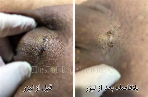  طول درمان زگیل تناسلی