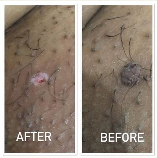  آیا کرایوتراپی زگیل تناسلی درد دارد؟