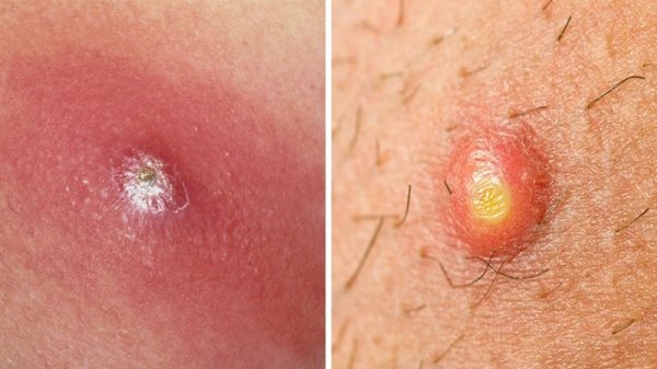  آیا جوش مقعدی خطرناک است؟