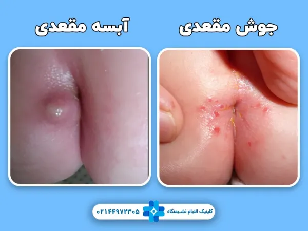 آیا جوش مقعدی خطرناک است؟