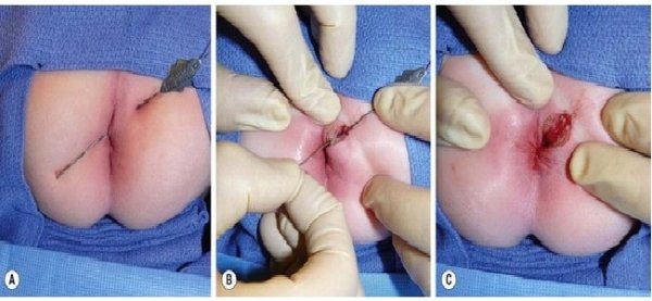  آیا جوش مقعدی خطرناک است؟