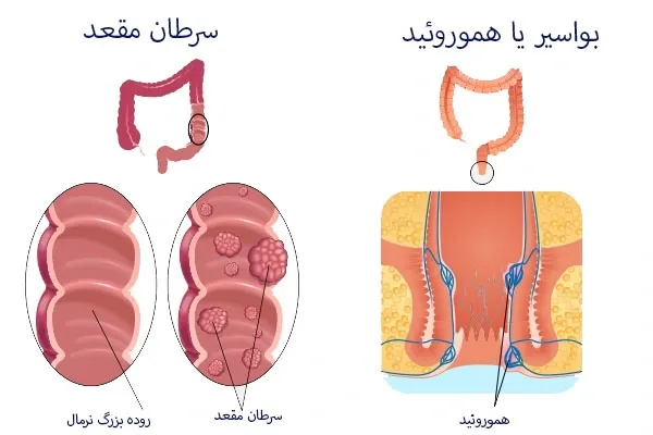  عکس سرطان مقعدی