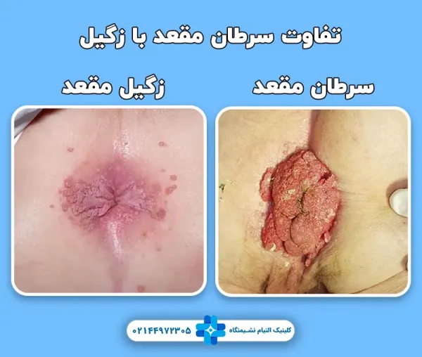  عکس سرطان مقعدی
