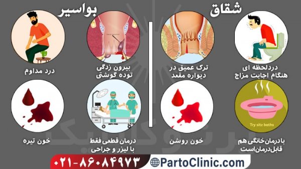  تفاوت شقاق و سرطان روده
