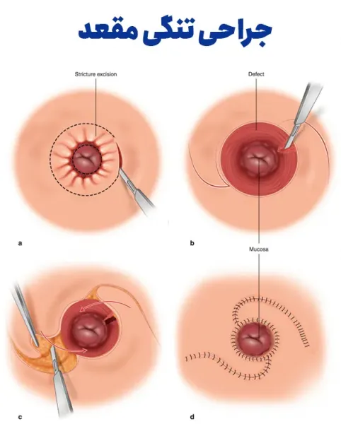  درمان تنگی مقعدی از نظر اسلام