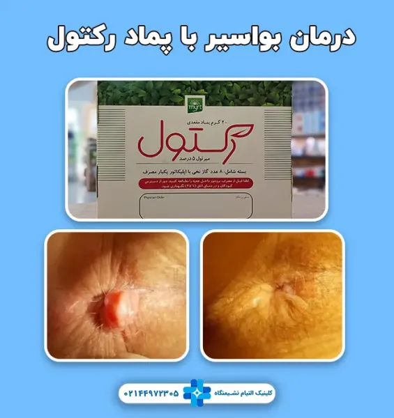  نظرات درباره پماد رکتول