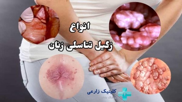  عکس واضح از زگیل تناسلی زنان نی نی سایت