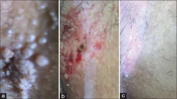  عکس واضح از زگیل تناسلی زنان نی نی سایت