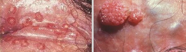  عکس واضح از زگیل تناسلی زنان نی نی سایت