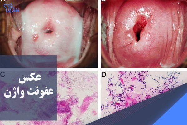 بیماری های واژن با عکس
